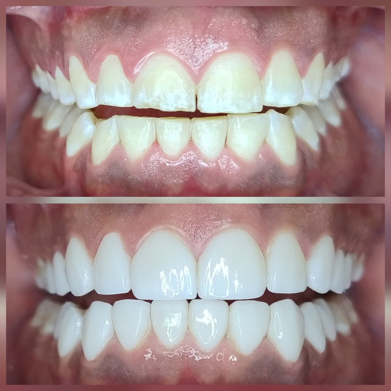 Diseño de sonrisa con lentes cerámicos