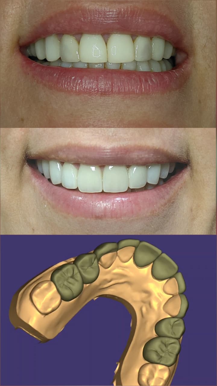 Diseño de sonrisa combinado, coronas y lentes cerámicos
