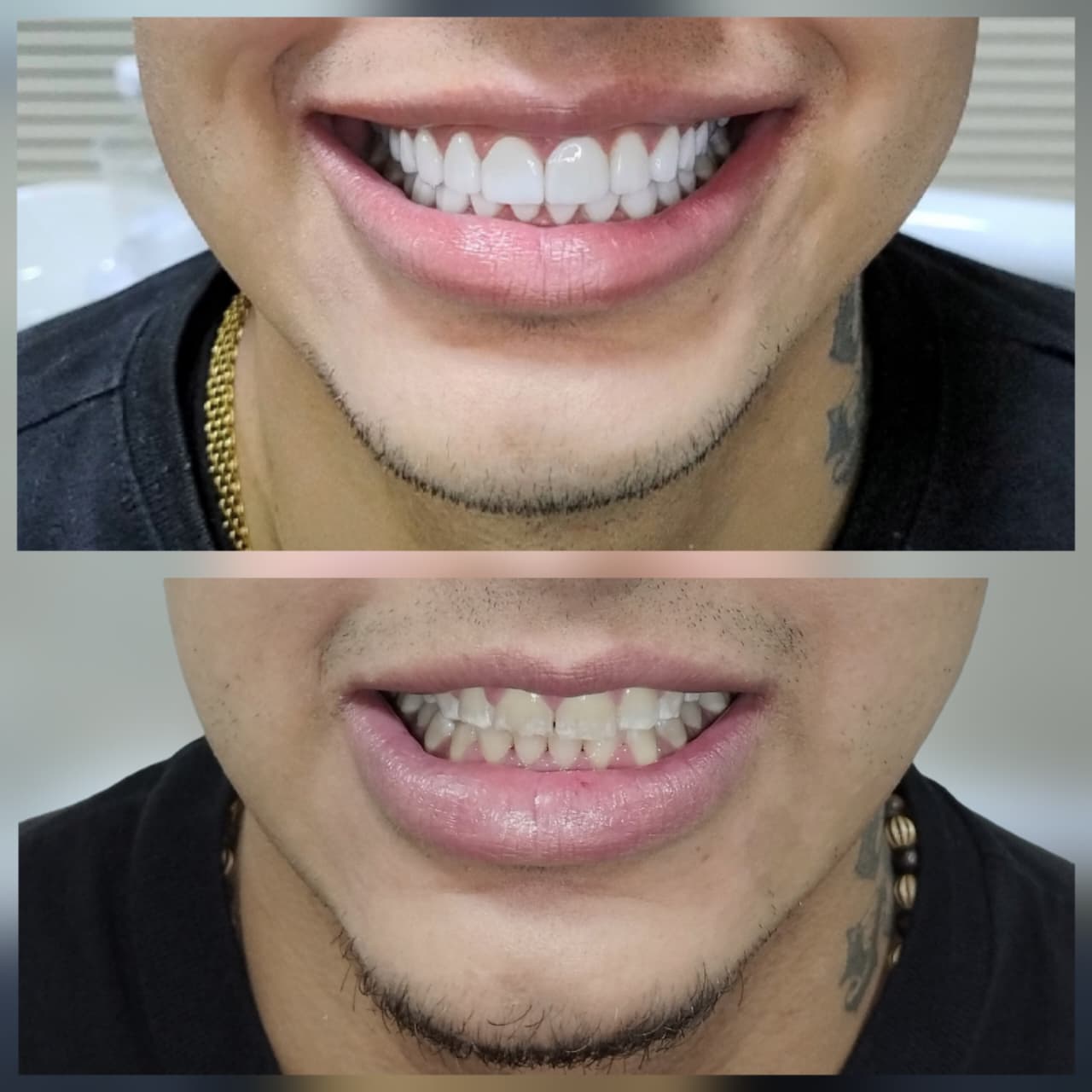 Diseño de sonrisa con lentes cerámicos, técnica CAD-CAM